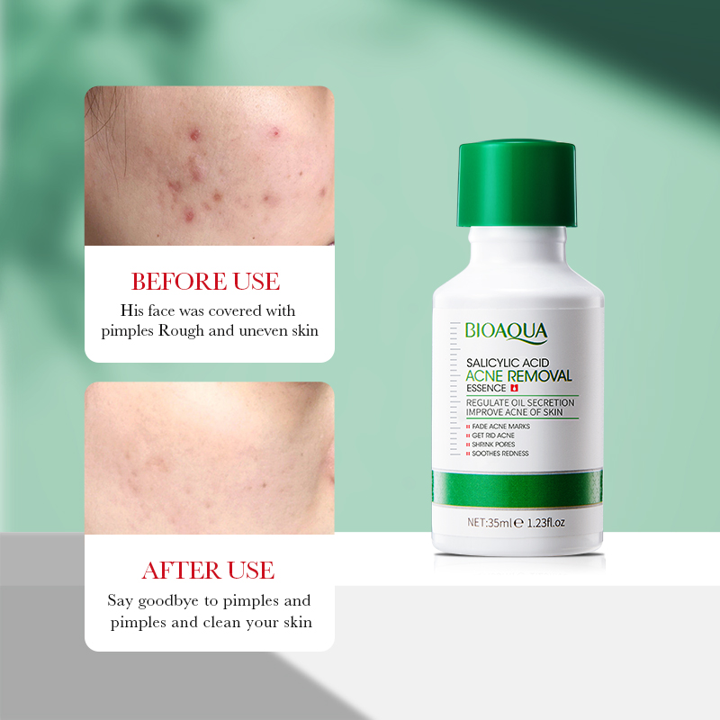 35ml BIOAOUA Salicylzuur Anti- - Salicylic Acid Blackhead Remover recensie en prijs